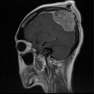 甲状腺濾胞癌の頭蓋骨転移 頭部MRI 甲状腺濾胞癌の頭蓋骨転移 頭部MRI